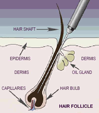 hair-removal-electrolysis